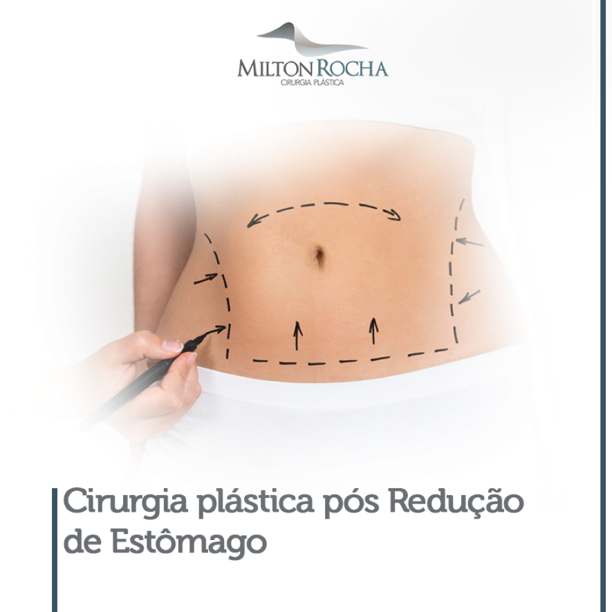 Leia mais sobre o artigo Cirurgia plástica após Gastroplastia