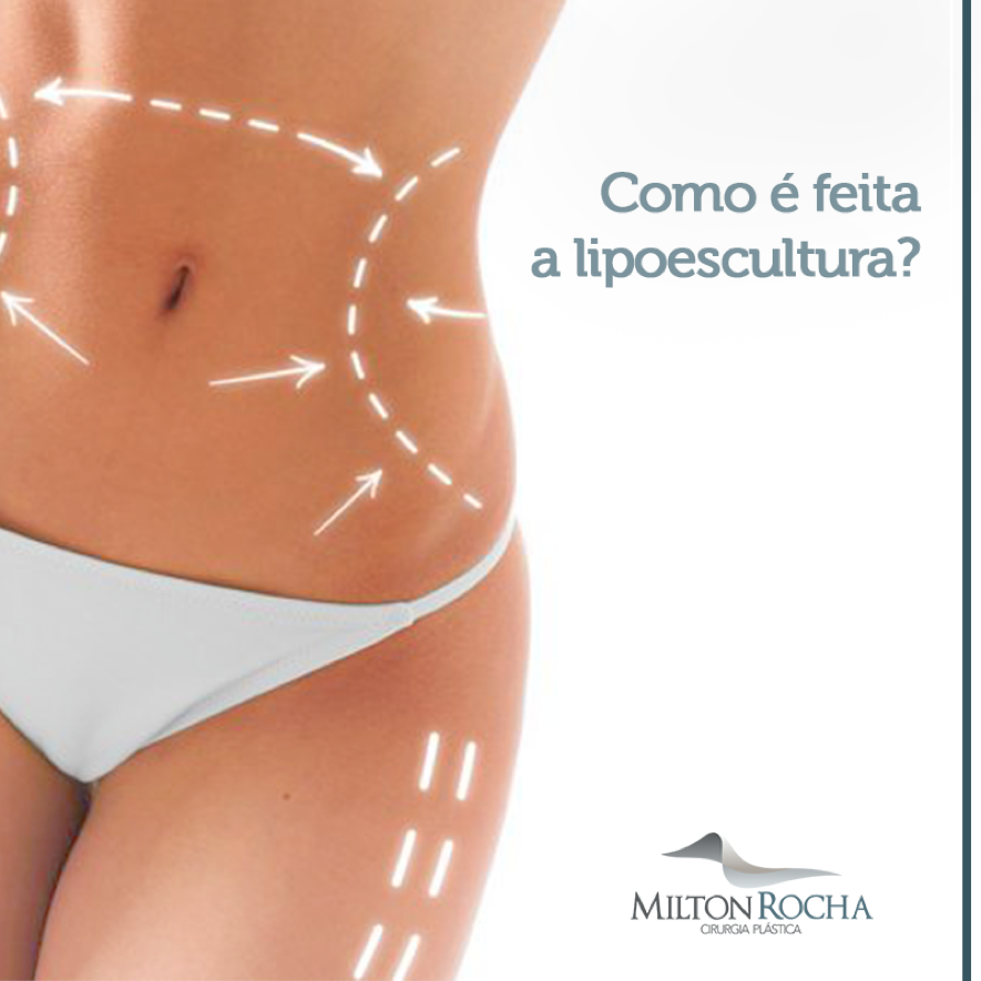 Leia mais sobre o artigo Como é feita a lipoescultura?