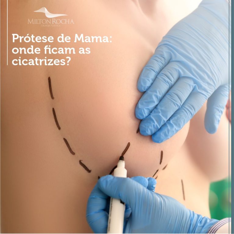 Leia mais sobre o artigo PRÓTESE DE MAMA: ONDE FICAM AS CICATRIZES?