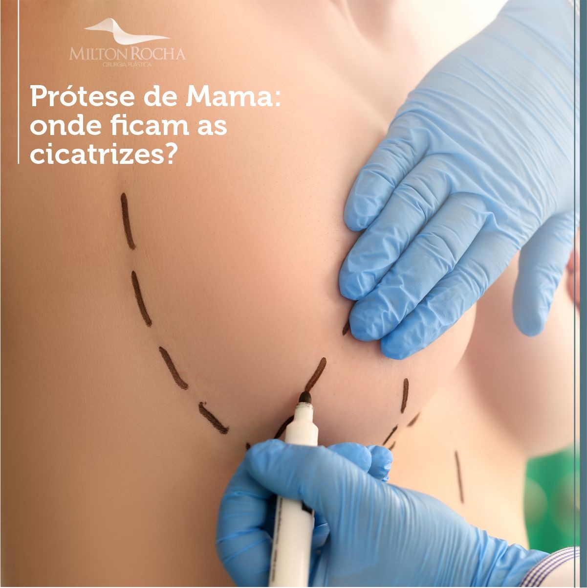 No momento, você está visualizando PRÓTESE DE MAMA: ONDE FICAM AS CICATRIZES?