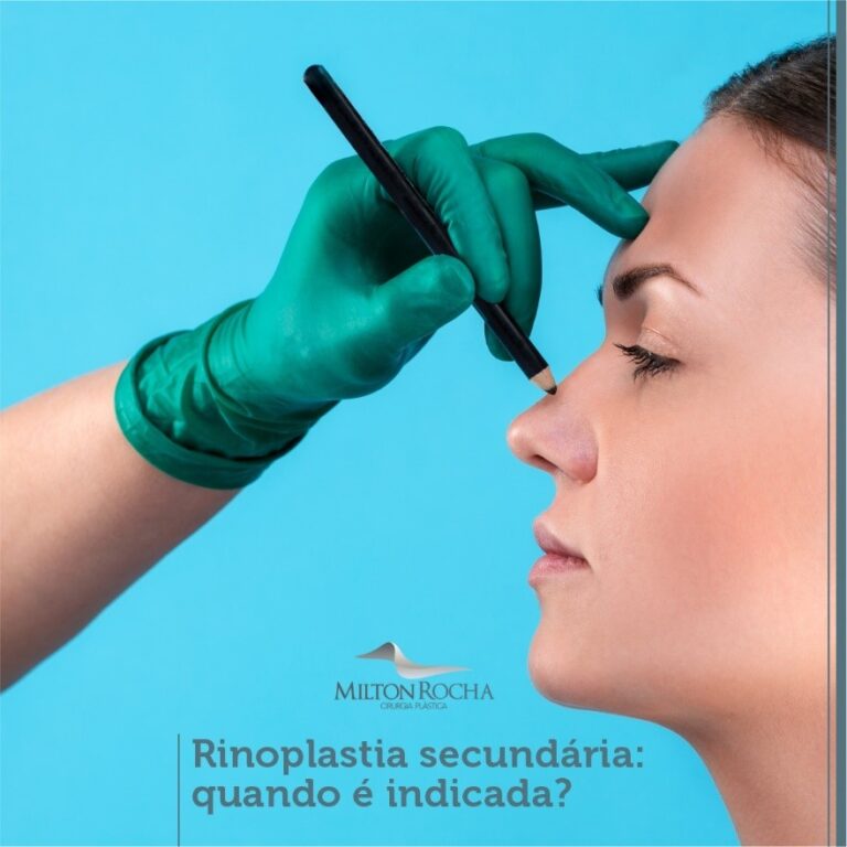 Leia mais sobre o artigo Cirurgia Plástica Recife – Rinoplastia secundária: quando é indicada?