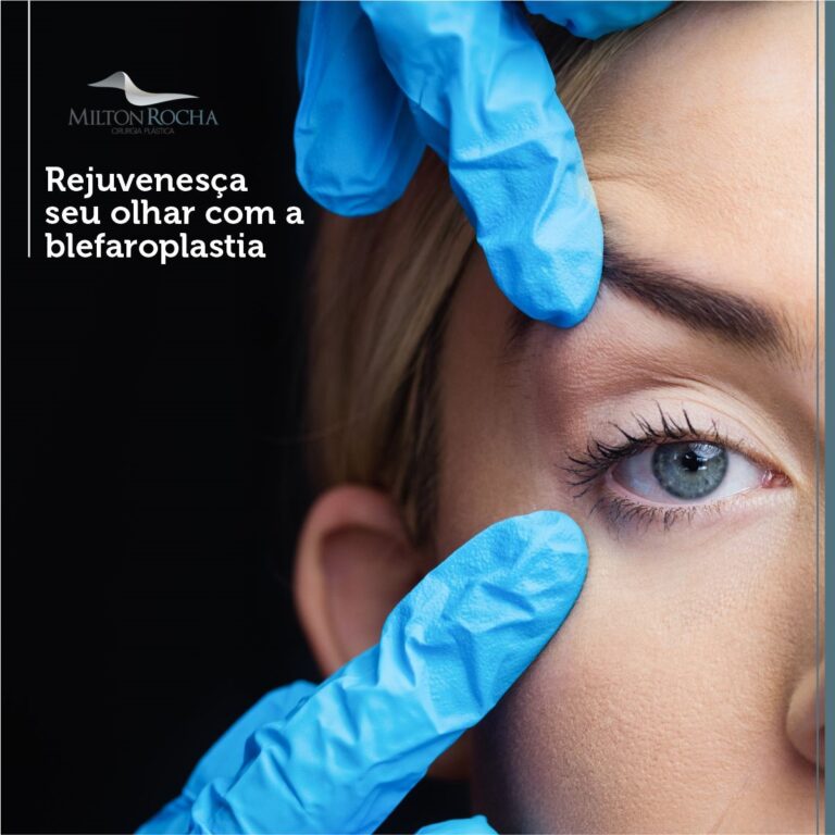 Leia mais sobre o artigo Cirurgia Plástica Recife – Rejuvenesça seu olhar com a blefaroplastia