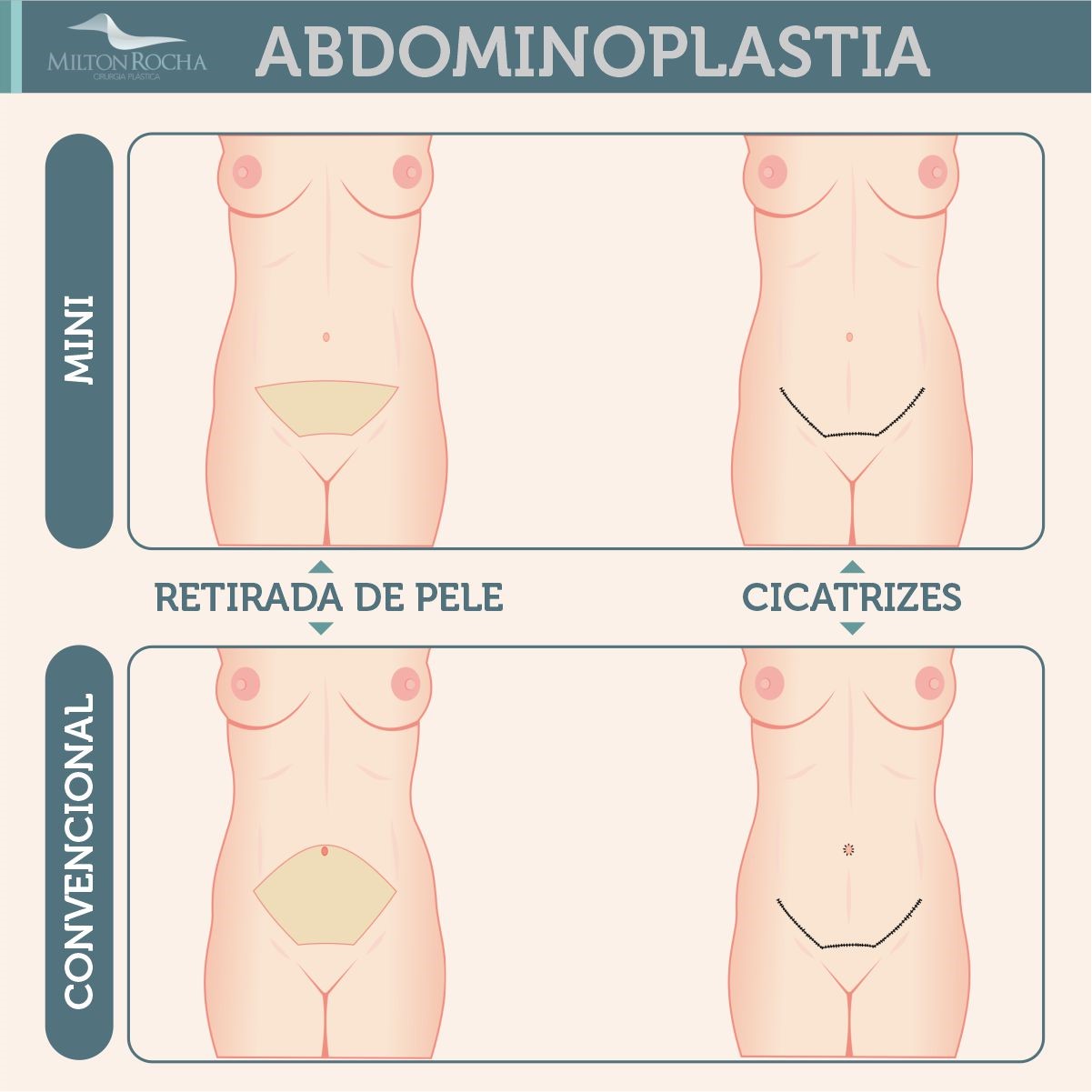 No momento, você está visualizando Cirurgia Plástica Recife | Abdominoplastia