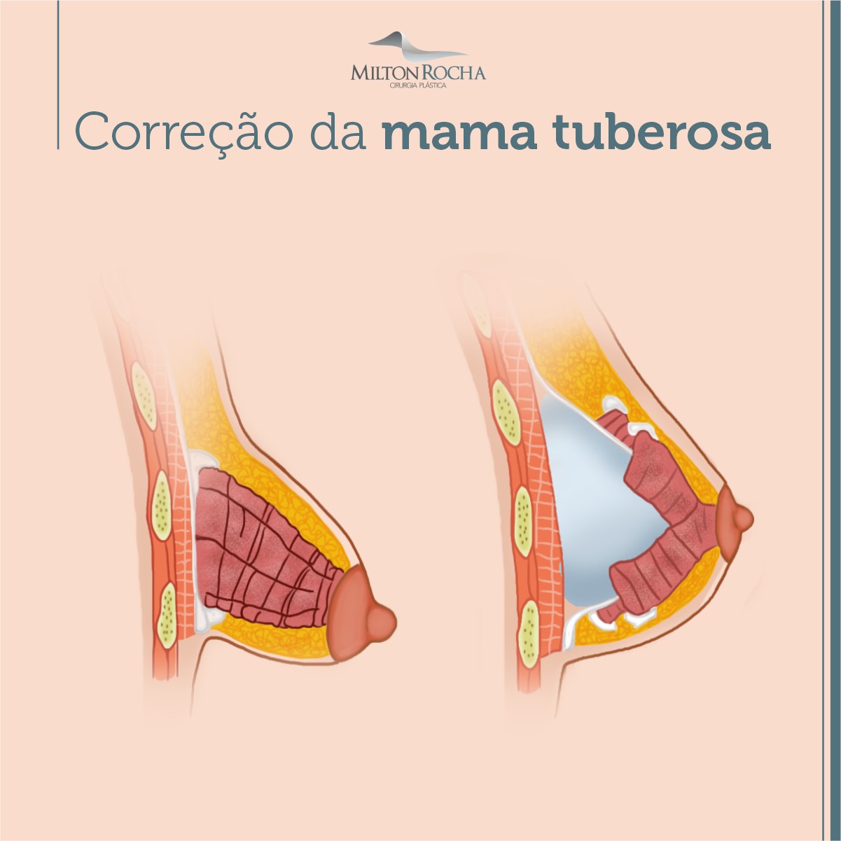 No momento, você está visualizando Cirurgia Plástica Recife – Correção da mama tuberosa