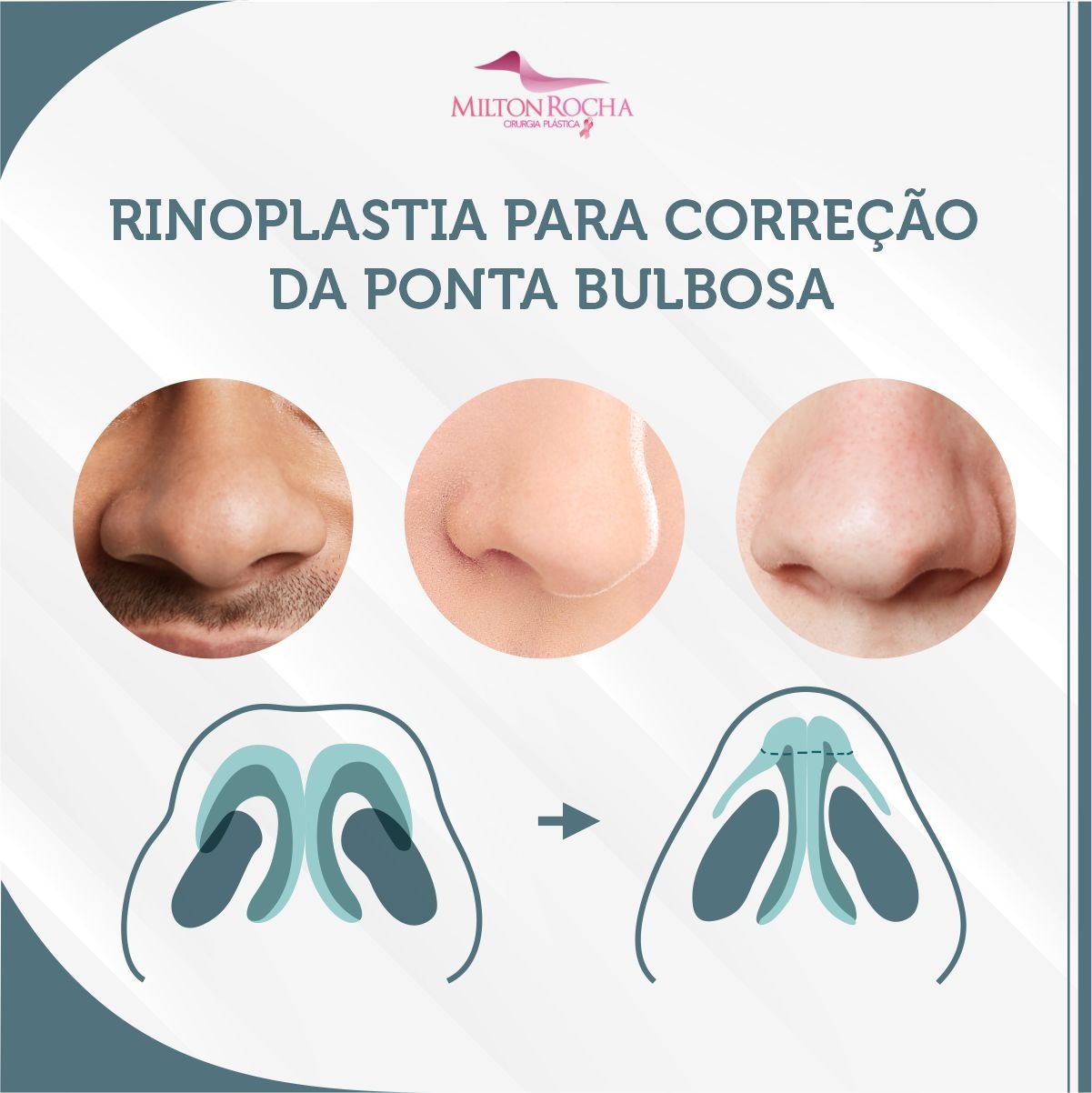 No momento, você está visualizando Cirurgia Plástica Recife – Rinoplastia para correção da ponta bulbosa
