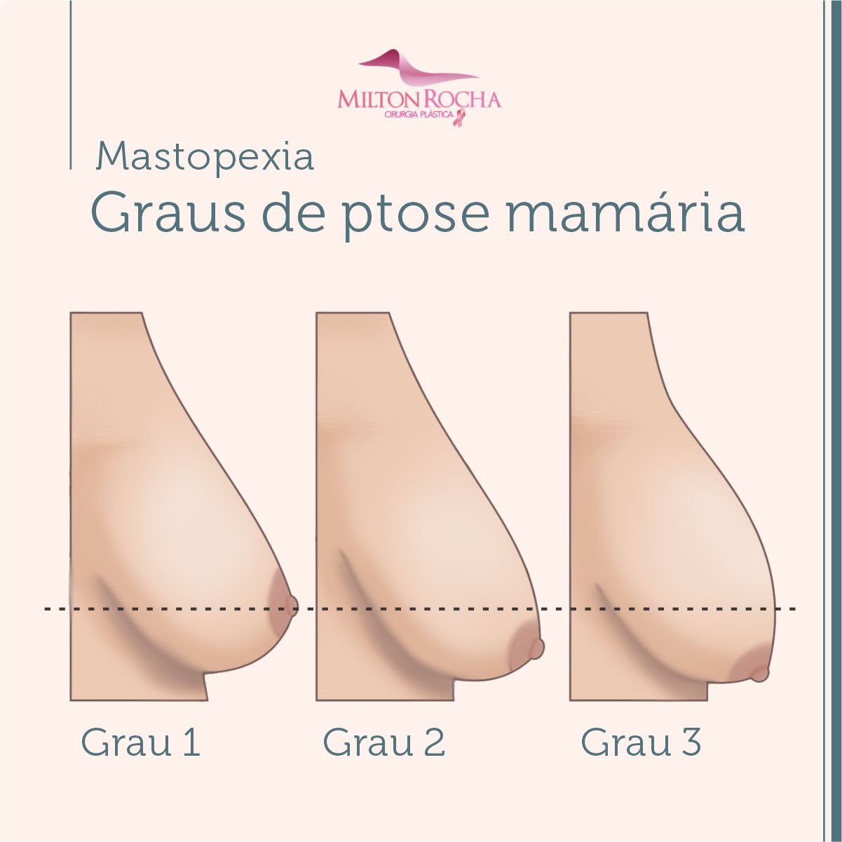 No momento, você está visualizando Cirurgia Plástica Recife – Graus de ptose mamária