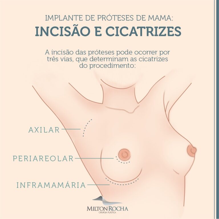 Leia mais sobre o artigo Cirurgia Plástica Recife – Implante de próteses de mama: Incisão e cicatrizes