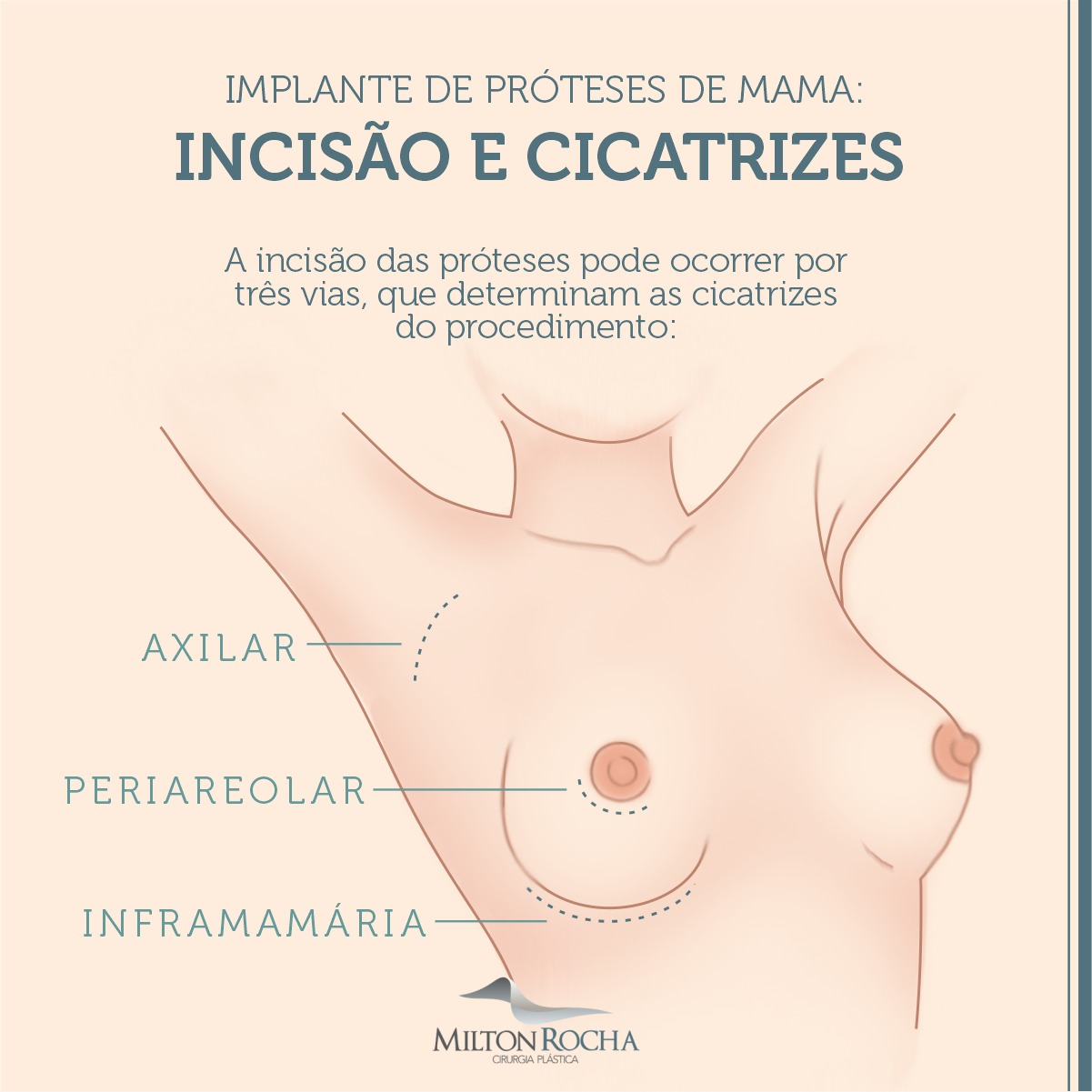 No momento, você está visualizando Cirurgia Plástica Recife – Implante de próteses de mama: Incisão e cicatrizes