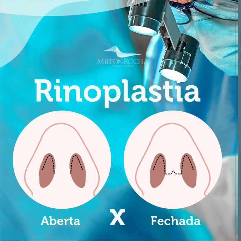 Leia mais sobre o artigo Cirurgia Plástica Recife – Rinoplastia
