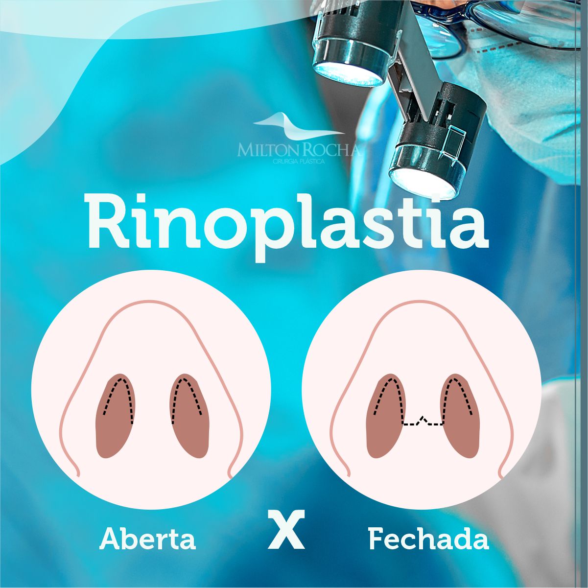 No momento, você está visualizando Cirurgia Plástica Recife – Rinoplastia