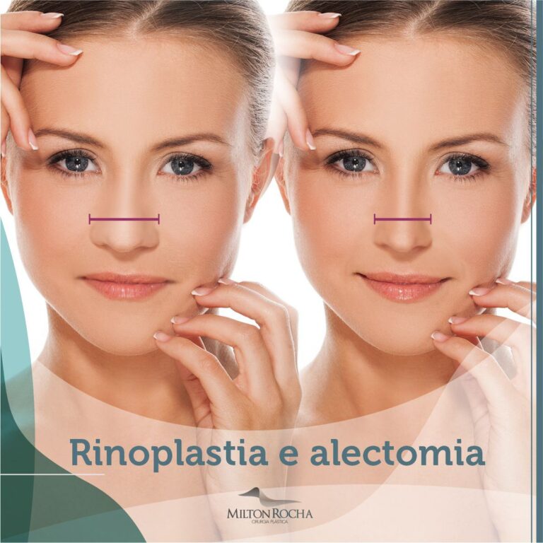 Leia mais sobre o artigo Cirurgia Plástia Recife – Rinoplastia e Alectomia