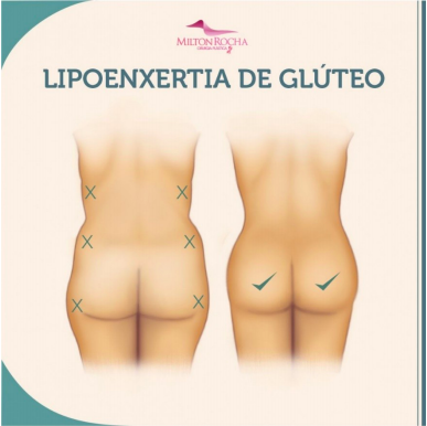 No momento, você está visualizando Lipoenxertia de Glúteos