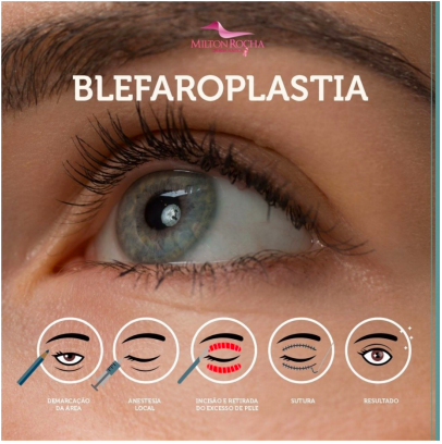 Leia mais sobre o artigo Cirurgia Plástica Recife – BLEFAROPLASTIA