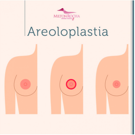 Leia mais sobre o artigo Cirurgia Plástica Recife – Areoloplastia