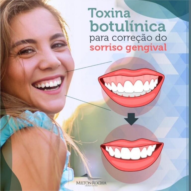 Leia mais sobre o artigo Cirurgia Plástica Recife – Toxina Butolínica para correção do sorriso gengival