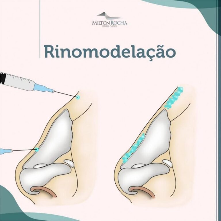 Leia mais sobre o artigo Cirurgia Plástica Recife – Rinomodelação