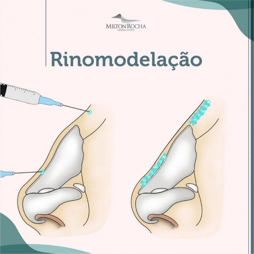 No momento, você está visualizando Cirurgia Plástica Recife – Rinomodelação