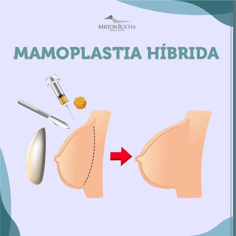 Leia mais sobre o artigo Cirurgia Plástica Recife – Mamoplatia híbrida