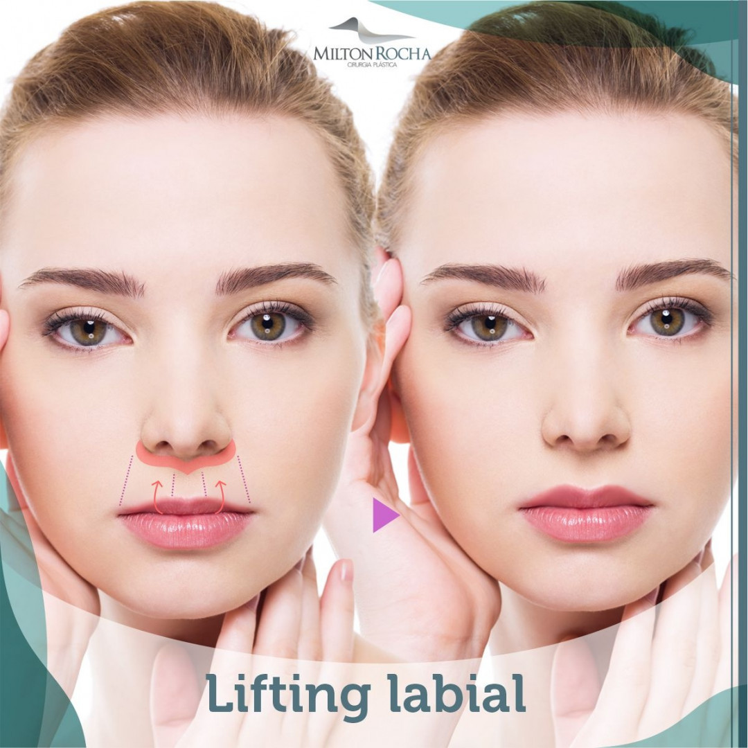 No momento, você está visualizando Cirurgia Plástica Recife – Lifting labial