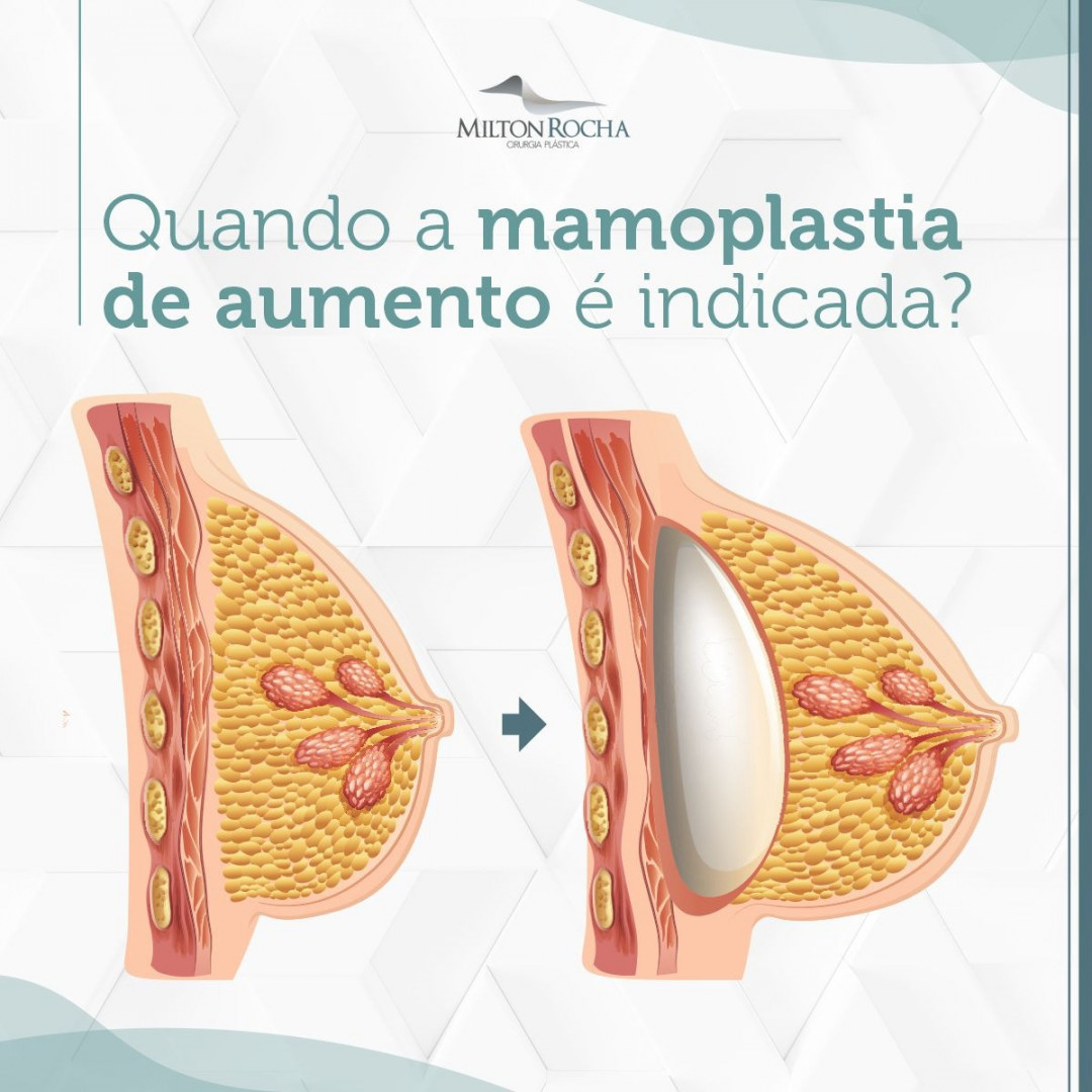 No momento, você está visualizando Cirurgia Plástica Recife – Quando a mamoplastica de aumento é indicada?