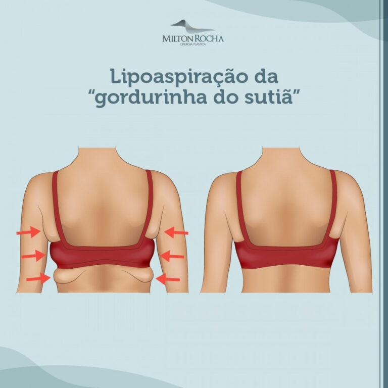 Leia mais sobre o artigo Cirurgia Plástica Recife – Lipoaspiração da “gordurinha do sutiã”
