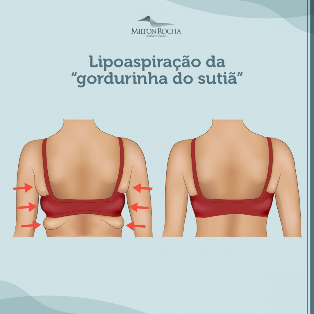 No momento, você está visualizando Cirurgia Plástica Recife – Lipoaspiração da “gordurinha do sutiã”