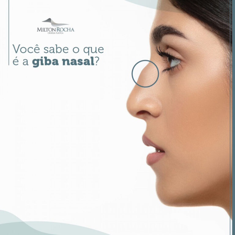 Leia mais sobre o artigo Cirurgia Plástica Recife – Você sabe o que é a GIBA nasal?
