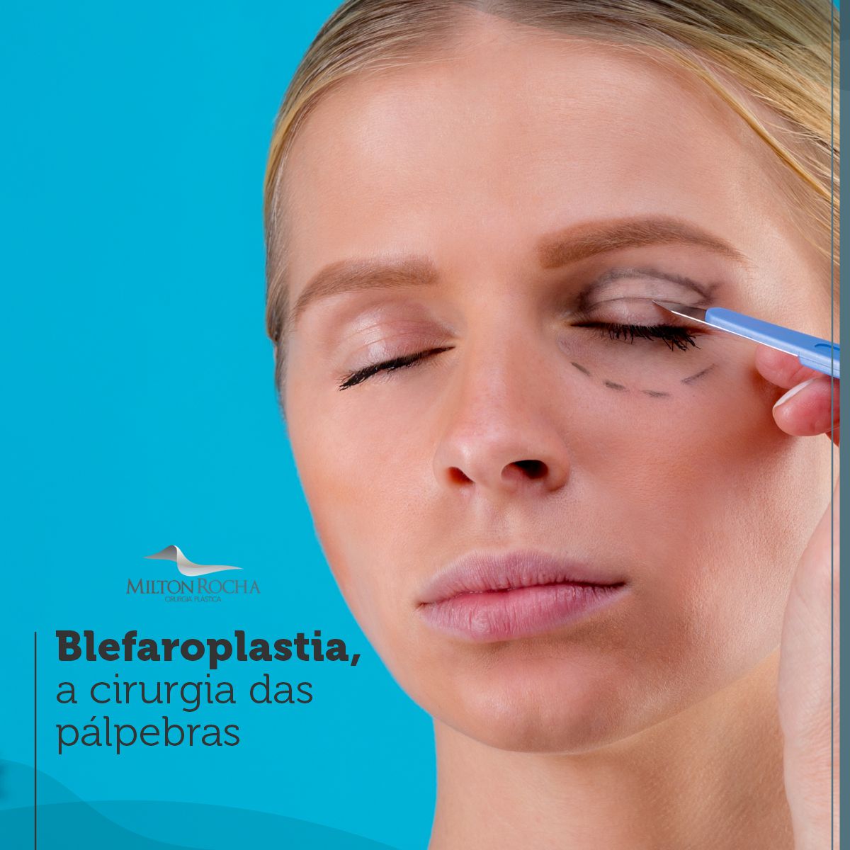 No momento, você está visualizando Cirurgia Plástica Recife – Blefaroplastia, a cirurgia das pálpebras