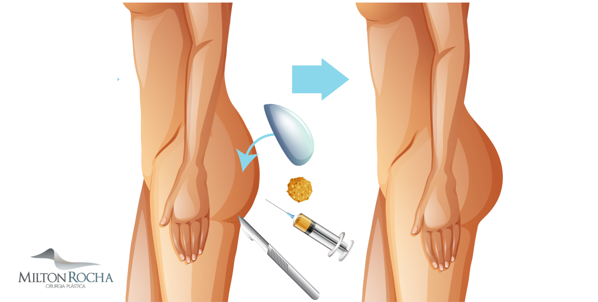 No momento, você está visualizando Cirurgia Plástica Recife – GLUTEOPLASTIA X LIPOENXERTIA GLUTÉA